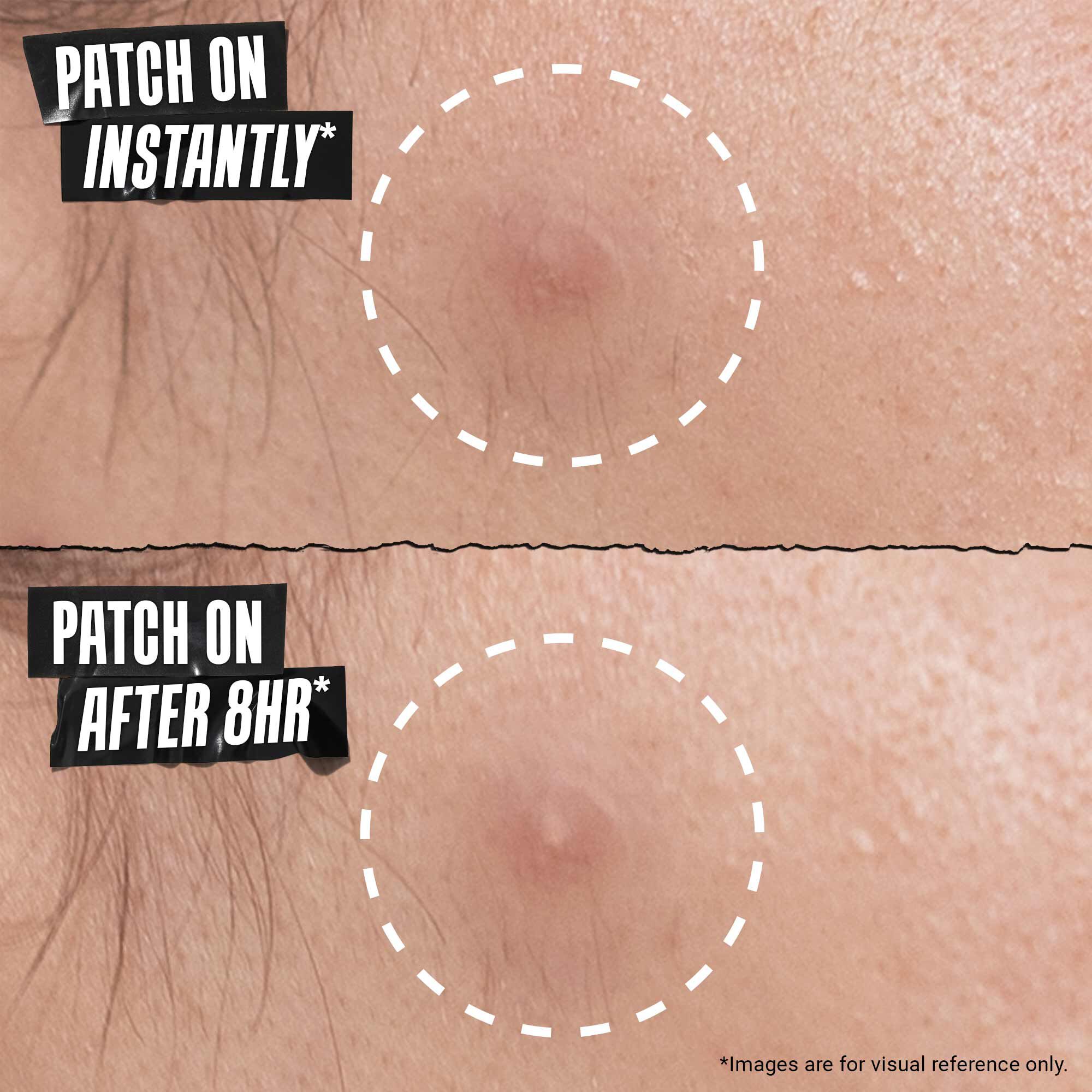 Truly Targeted Overnight Blemish Patch
