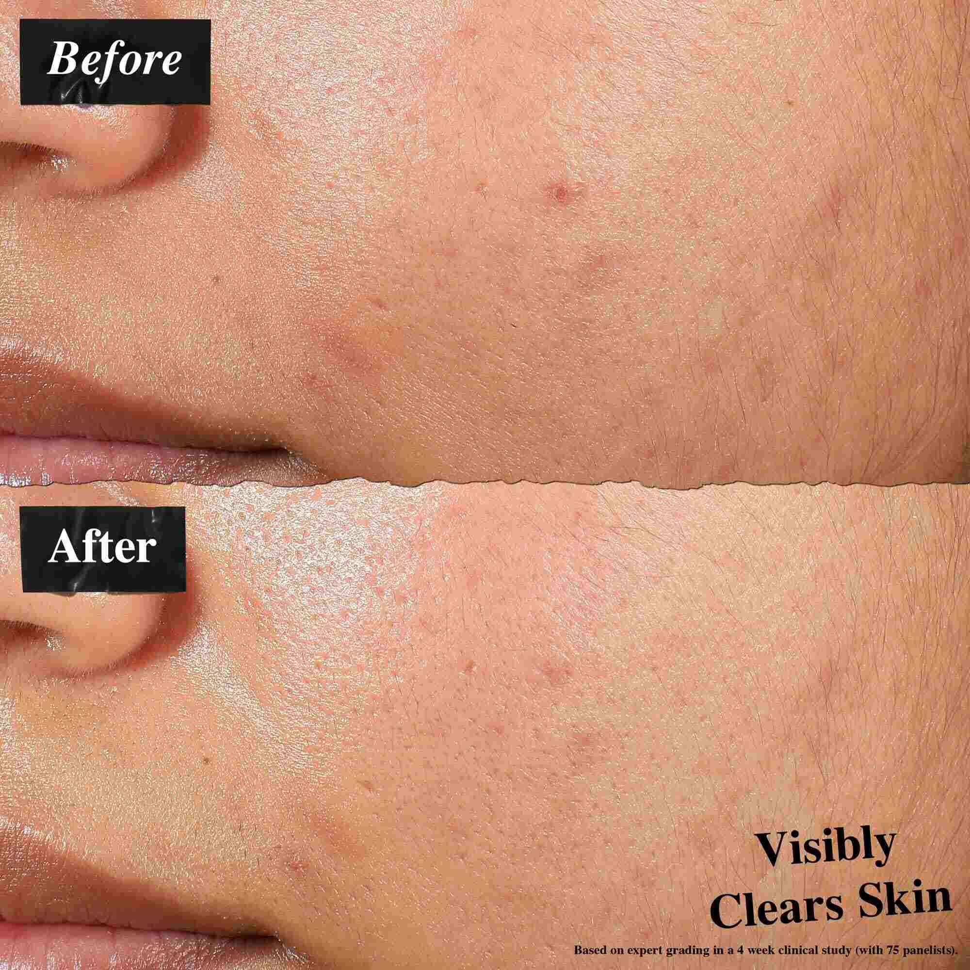Porownanie przed i po pokazujące skorę po zastosowaniu balsamu Expertly Clear Blemish-Treating & Preventing Lotion. Zdjęcie „przed” pokazuje niedoskonałości i nierowną teksturę, a zdjęcie „po” widocznie czystszą skorę.