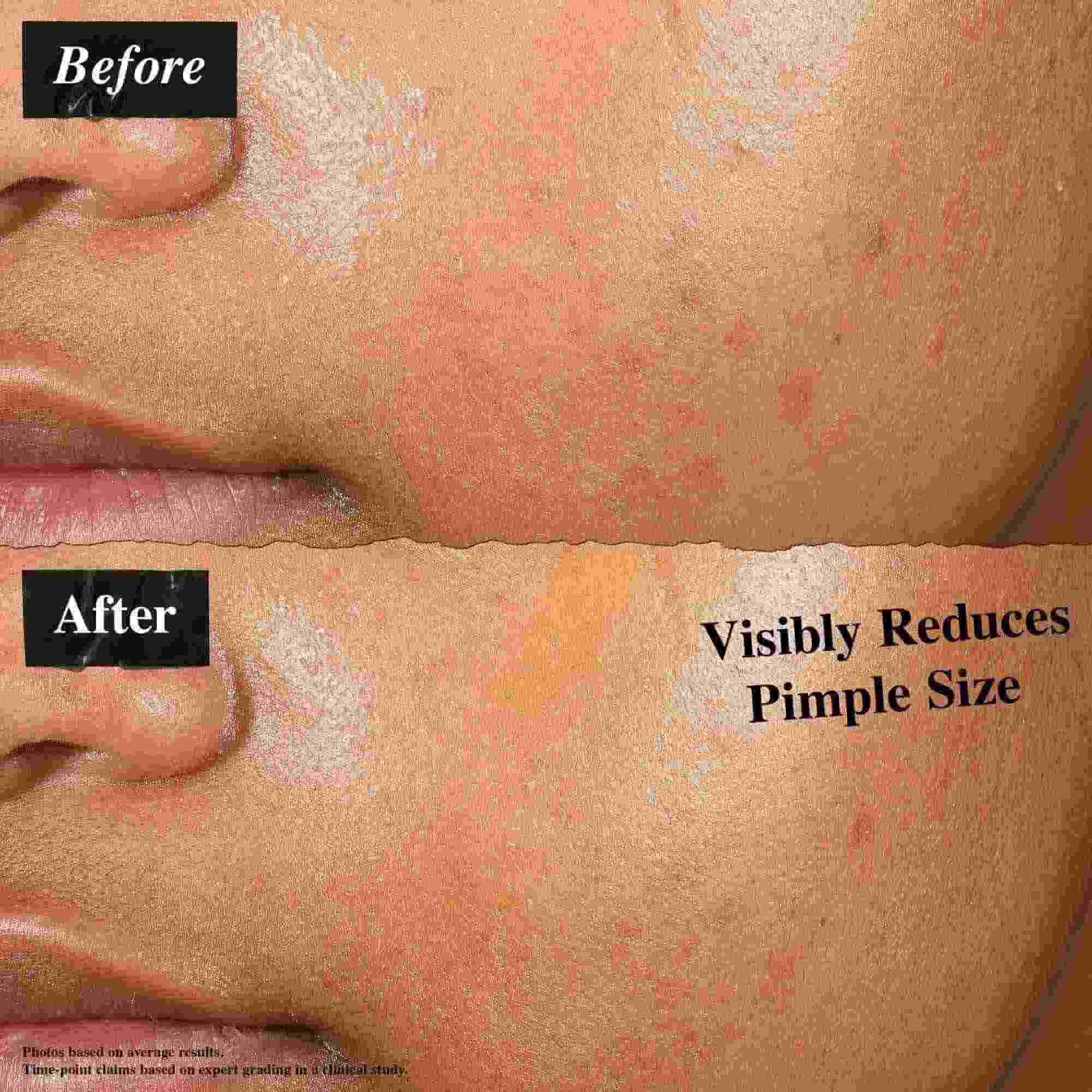 Porownanie przed i po pokazujące skorę potraktowaną Truly-Targeted Blemish-Clearing Solution. Zdjęcie „przed” pokazuje widoczne pryszcze, podczas gdy zdjęcie „po” pokazuje zmniejszony rozmiar pryszczy.