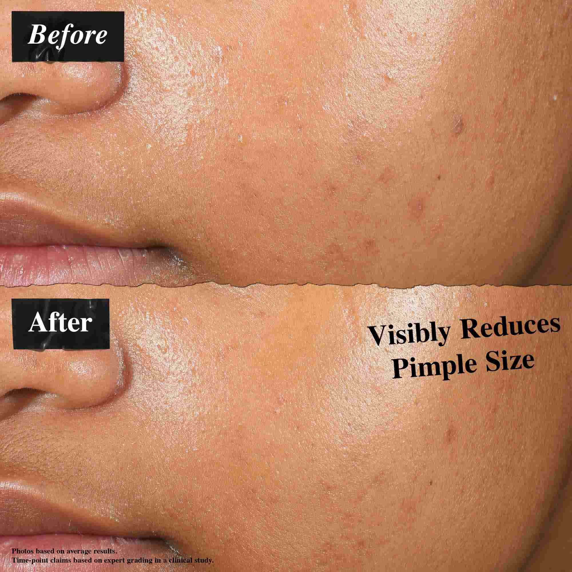 Porownanie przed i po pokazujące skorę potraktowaną Truly-Targeted Blemish-Clearing Solution. Zdjęcie „przed” pokazuje widoczne pryszcze, podczas gdy zdjęcie „po” pokazuje zmniejszony rozmiar pryszczy.