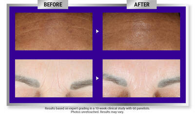 Before-and-after comparison showing skin texture improvement. The "before" image displays uneven skin with visible wrinkles, while the "after" image shows smoother skin with reduced signs of aging.
