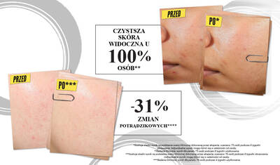 Comparison image showing before and after results of acne treatment. The "before" photos display skin with blemishes, while the "after" photos show clearer skin, highlighting 100% of users experienced acne clearing and a 31% reduction in post-blemish marks.