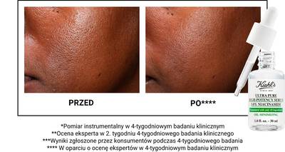 Alt text: A side-by-side comparison of skin before and after 4 weeks of using Kiehl's Ultra Pure High-Potency Serum with Niacinamide. The "before" image shows uneven texture, while the "after" image reveals smoother skin. A dropper bottle of the serum is shown in the corner.