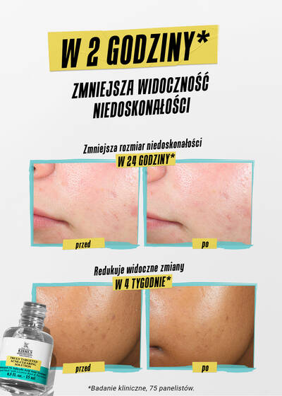 Alt text: A comparison image showing the effects of a skincare product on acne. The top two panels show before and after results of reduced pimple color in 2 hours, with noticeable color improvement. The middle panels depict before and after results of reduced pimple size in 24 hours, showing smaller pimples after treatment. The bottom panels illustrate before