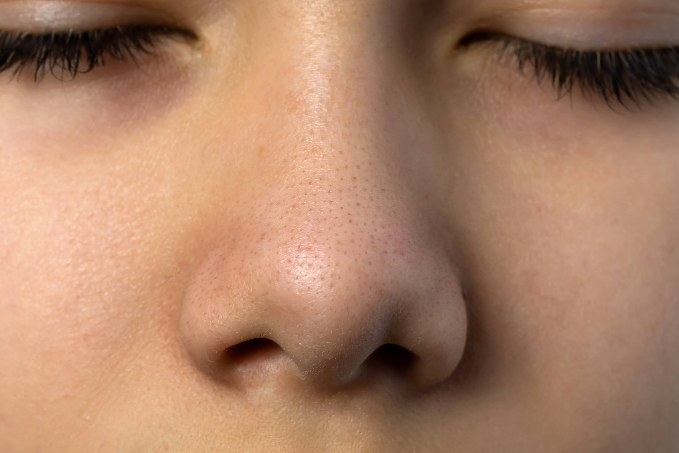 Zbliżenie na wągry na nosie